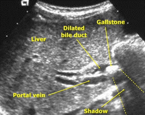 common bile duct ultrasound. Bile duct dilation – It is a