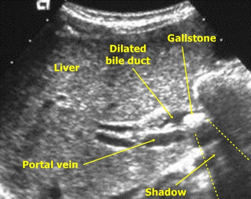 common bile duct obstruction. 2010 the common bile duct and