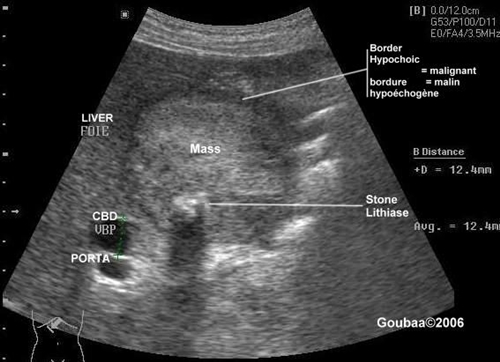 What happens during a gallbladder ultrasound?