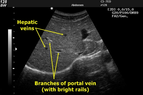 ultrasound portal vein