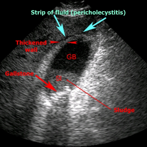 Acute Cholecystitis - Sonography