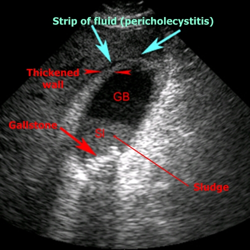 Acute cholecystitis - sonography