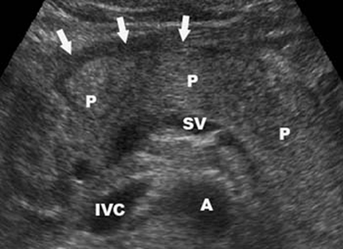 Acute pancreatitis - sonography