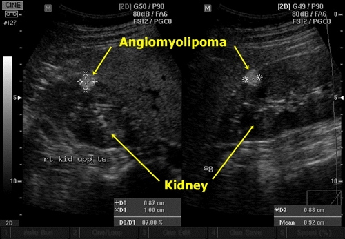 Angiomyolipoma - sonography