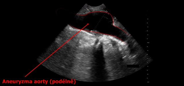 Ultrazvuk brisni aorty - aneurysma