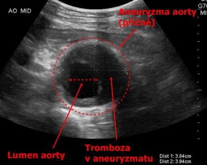 Ultrazvuk brisni aorty - aneurysma