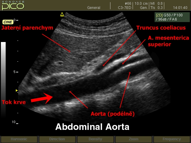 Ultrazvuk brisni aorty