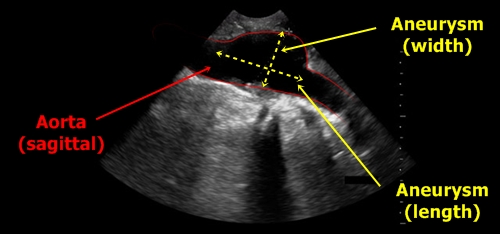 Aortic aneurysm - sonography