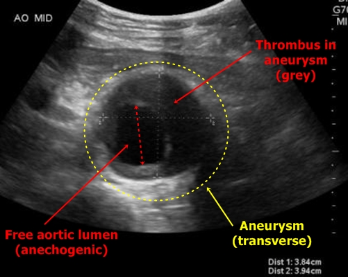 Thrombus in aortic aneurysm - sonography