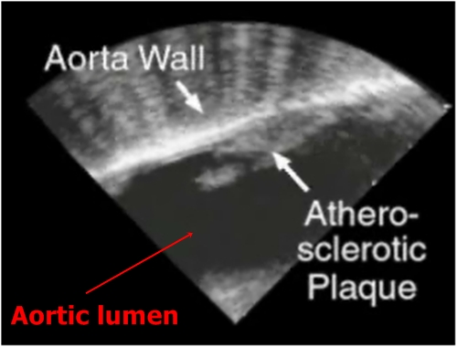 Atherosclerosis - sonography