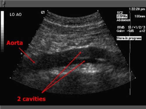 Aortic dissection - sonography