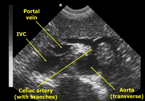 Aorta - sonography