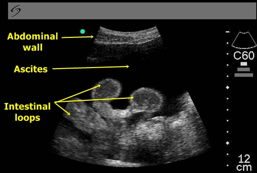 Ascites - Sonography