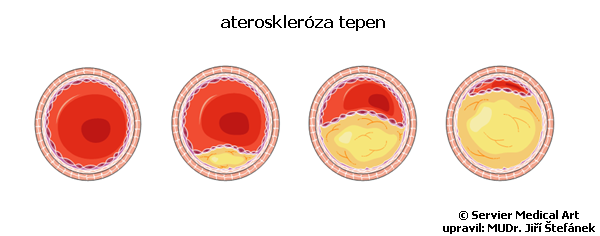 Ateroskleroza