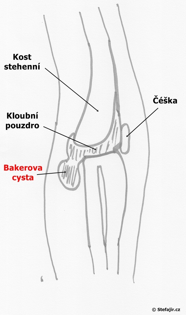 Bakerova cysta
