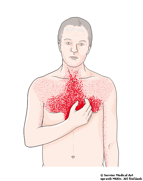 Hrca v hrdle a bolesti v hrudnej oblasti