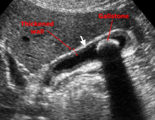 Chronic cholecystitis - sonography