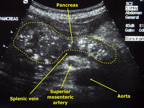 Chronic pancreatitis - sonography