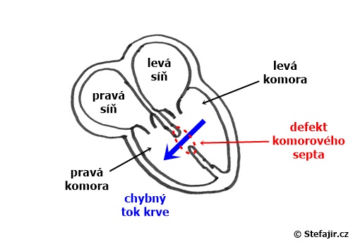 Defekt komoroveho septa