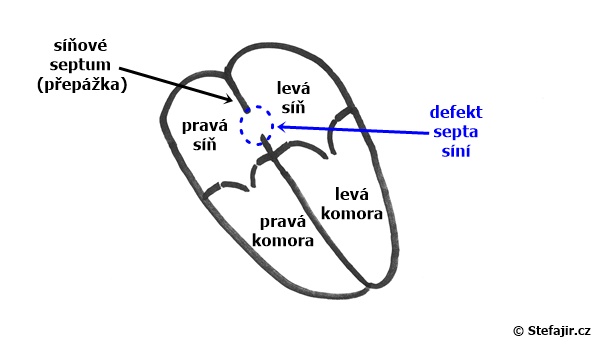 Defekt septa sini