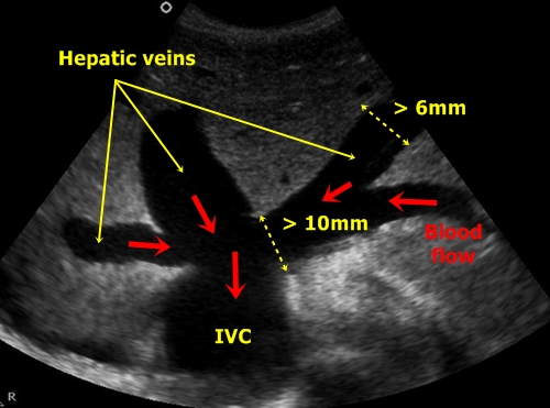 Dilated hepatic veins - sonography