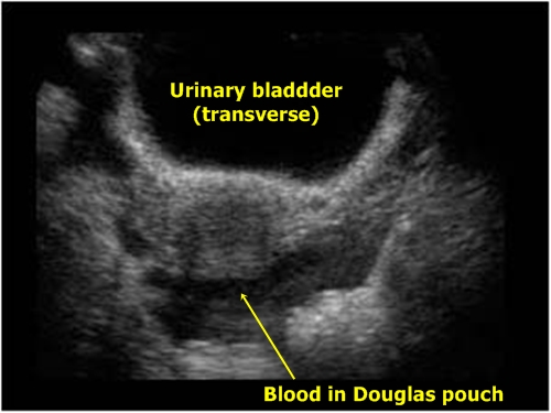 Blood in Douglas pouch - Sonography