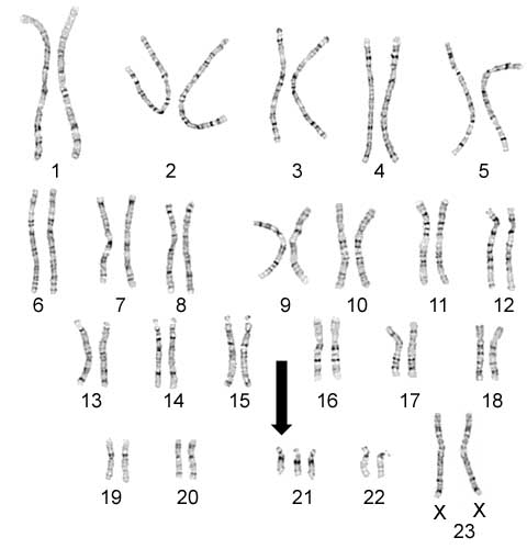 Chromozomy u Downova syndromu