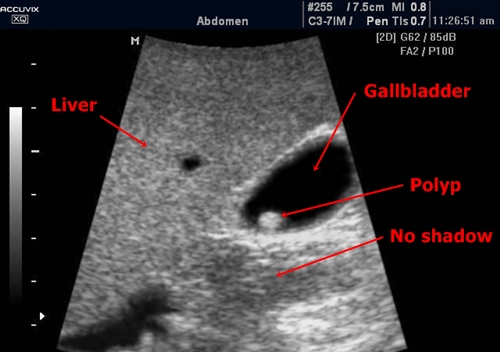 Gallbladder polyp - sonography