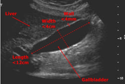 Gallbladder - sonography