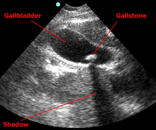 Gallstones - sonography