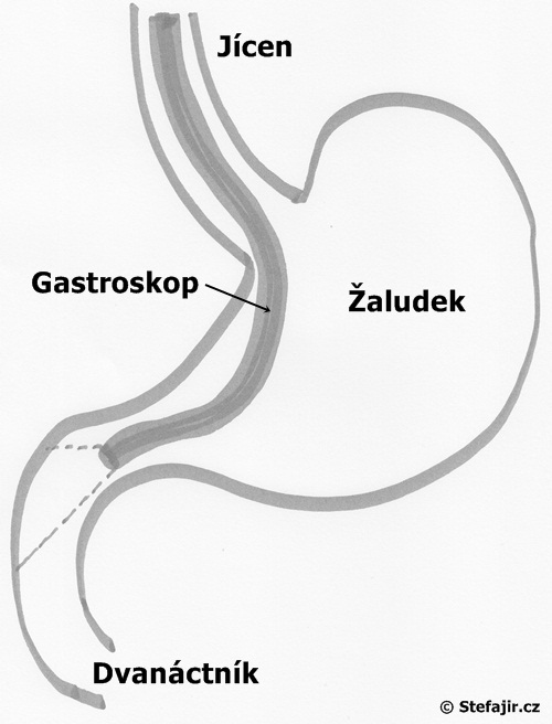 Gastroskopie