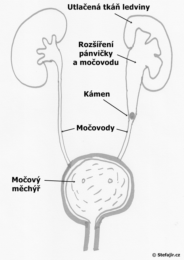 Hydronefróza a kamen