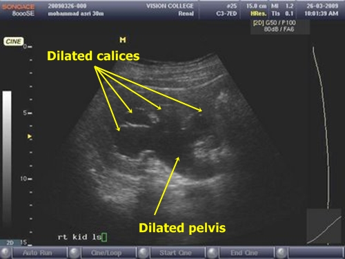 Hydronephrosis - sonography