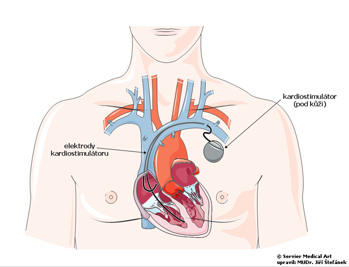 Kardiostimulator - schema