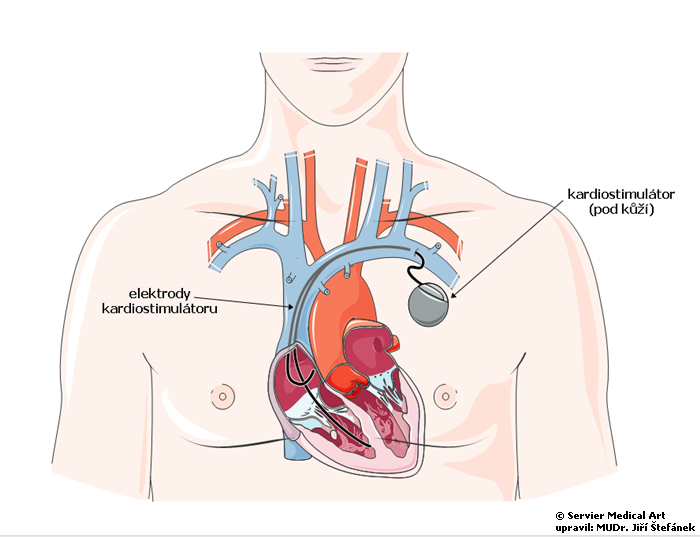 Na co je kardiostimulátor?