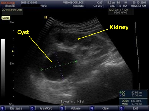 Renal cyst - sonography