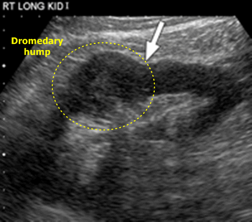 Kidney dromedary hump - sonography