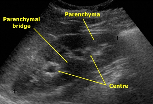 Kidney parenchymal bridge - sonography