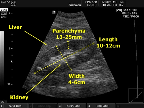 Kidney - sonography