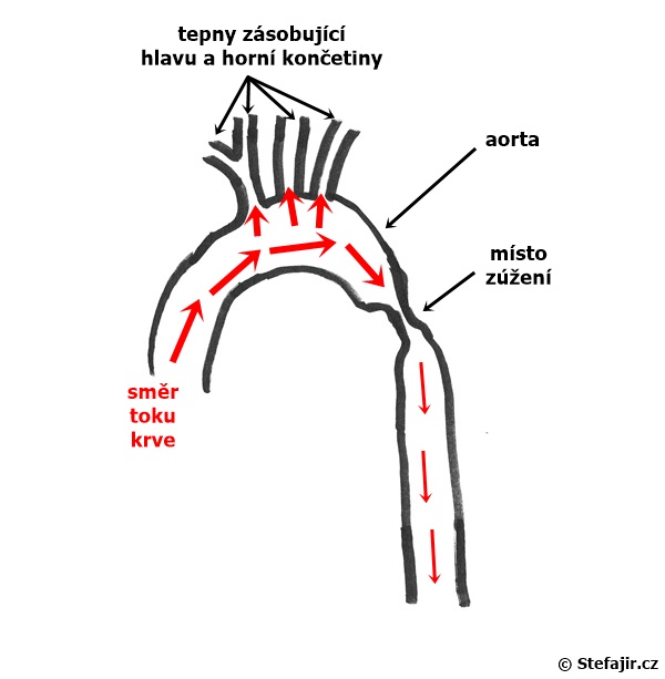 Koarktace aorty - schema