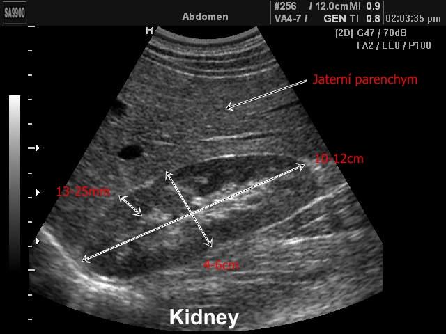 Ultrazvuk ledviny