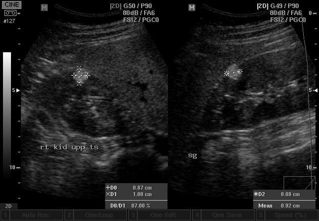 Ultrazvuk ledviny - angiomyolipom