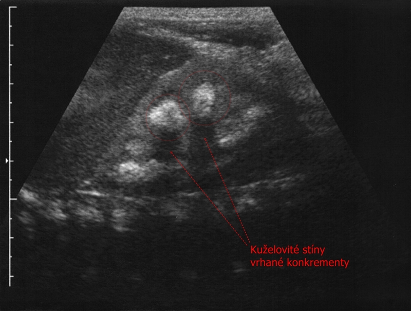 Ultrazvuk ledviny - nefrokalcinoza