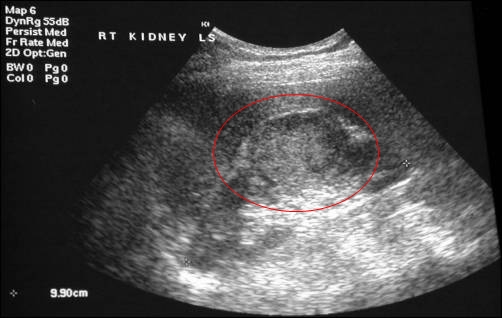 Ultrazvuk ledviny - tumor