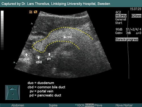 Lipomatous pancreas - sonography