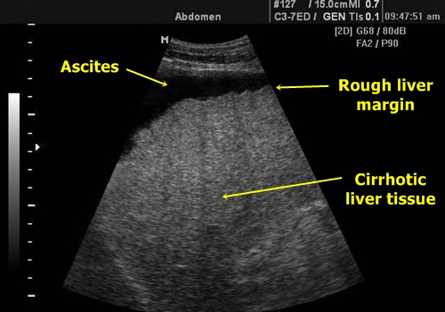 Liver cirrhosis - sonography