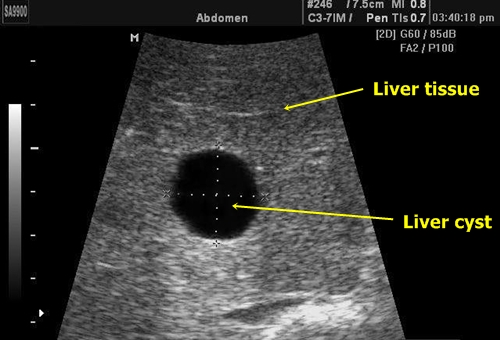 Liver cyst - sonography