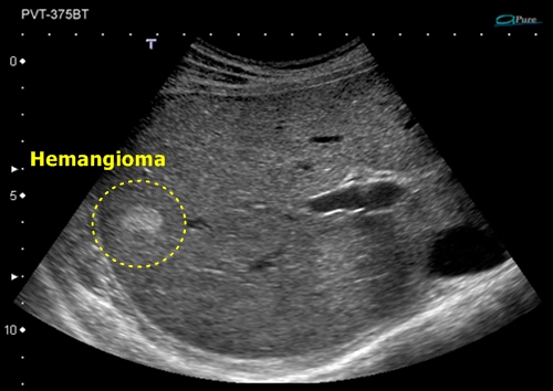 Liver hemangioma - sonography