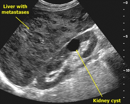 Liver metastases - sonography