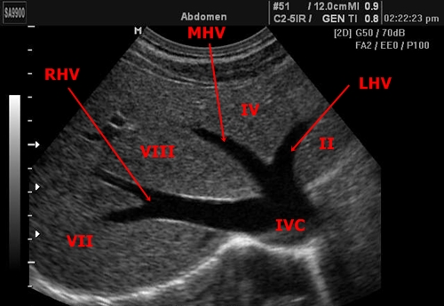 Liver segments - sonography